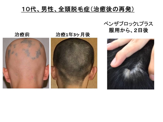円形脱毛症　病院""